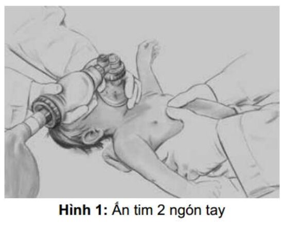 Bài giảng nhi khoa: Cấp cứu ngừng thở ngừng tim, dị vật đường thở