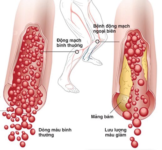 Bệnh động mạch chi dưới mạn tính