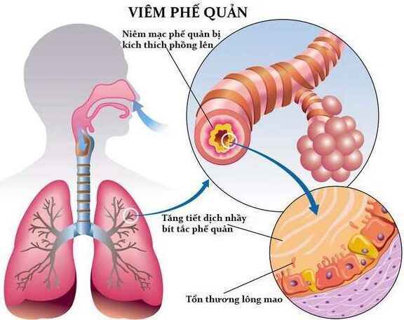 Chẩn đoán và điều trị lao nội mạc phế quản