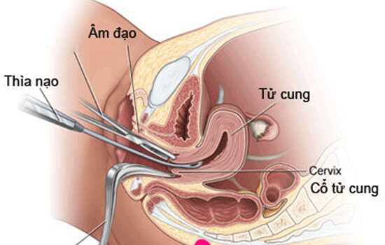 Phá Thai Từ 13 Đến 18 Tuần  Bằng Phương Pháp Nong Và Gắp Thai