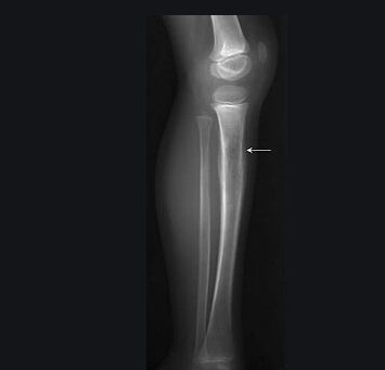 Sarcoma Ewing