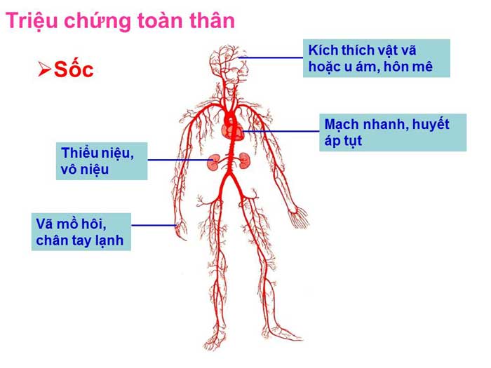 Sốc Giảm Thể Tích Tuần Hoàn Ở Trẻ Em - THƯ VIỆN MEDIPHARM