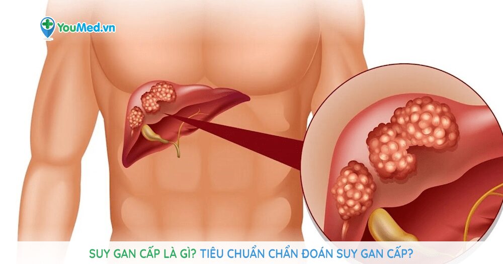 Suy gan cấp (Suy gan tối cấp)