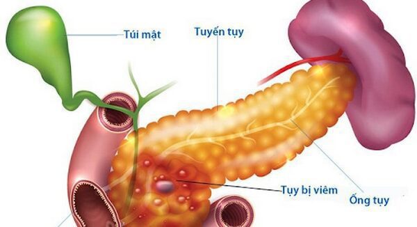 Viêm tụy mạn tính