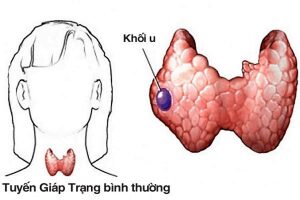 Cơ chế bệnh sinh và các nhân tố di truyền của bệnh Basedow