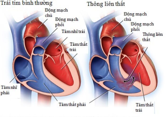 Biến chứng thường gặp và một số thể đặc biệt của nhồi máu cơ tim cấp