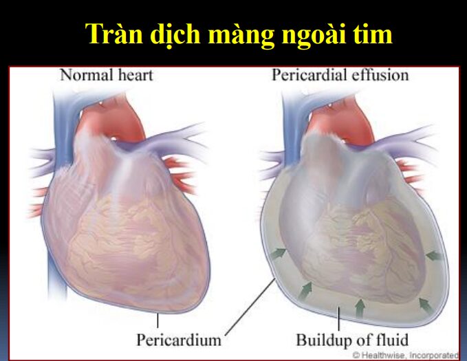 Cấp cứu tim mạch: Tràn dịch màng ngoài tim có ép tim cấp